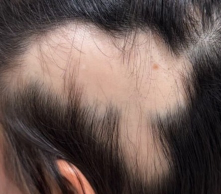Coral Gables Anti-Hair Loss Program for Lasting Results